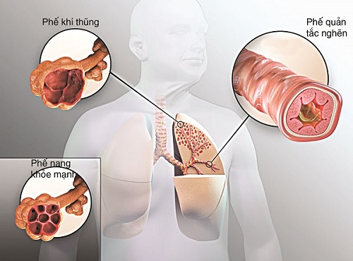 Viêm phổi là gì